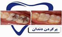 ترمیم دندان