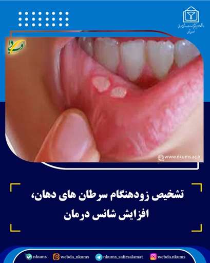 تشخیص زودهنگام سرطان های دهان